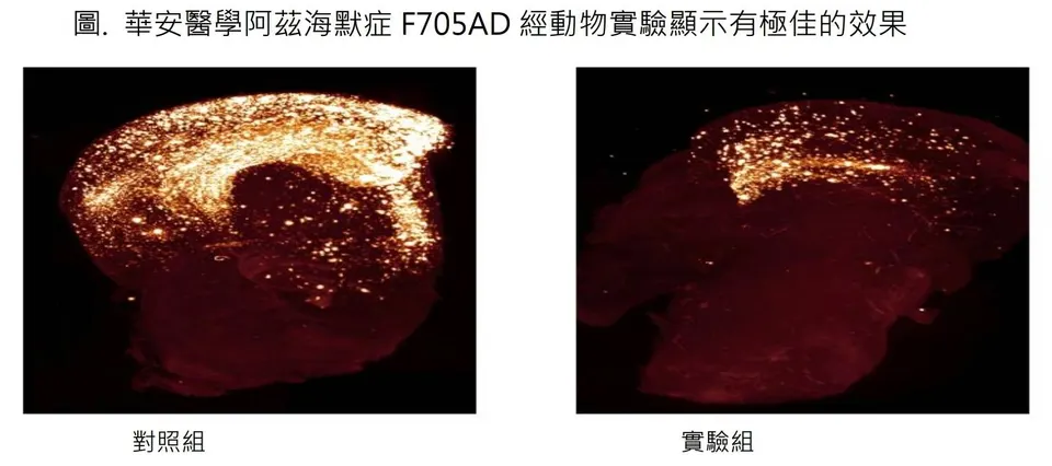 華安醫學巴金森氏症創新治療手段進入臨床試驗